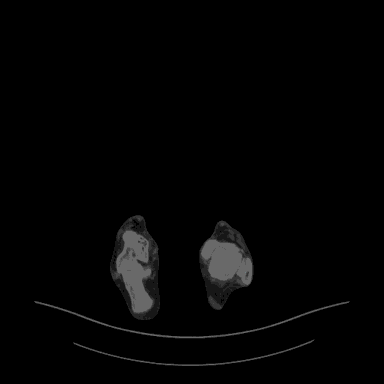Scrolling axial CT with MuscleMap muscle segmentation overlay